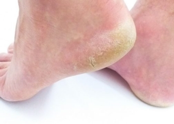 Si të parandaloni tharjen dhe çarjen e thembrave