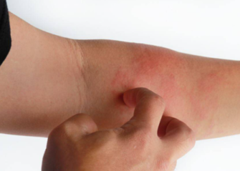 Mësoni se si ta trajtoni në mënyrë efektive lëkurën e skuqur gjatë dimrit