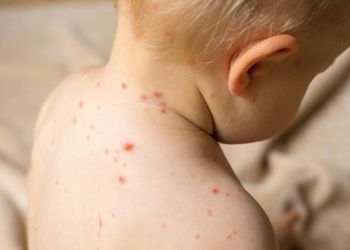 A mund të sëmureni dy herë nga lija?