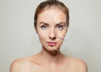 Tri  trajtime natyrale kundër pikave të zeza në fytyrë