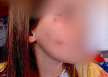 6-vjeçarja merr lëndime pasi u godit nga vetura në sheshin “Nënë Tereza”, shoferi ikë nga vendi i ngjarjes