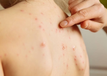 IKSHPK del me njoftim për lijën e majmunëve