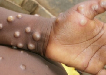 Në Hungari e Norvegji regjistrohen rastet e para me li të majmunit