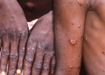 OBSH në alarm, lija e majmunëve shfaqet në Itali dhe Suedi