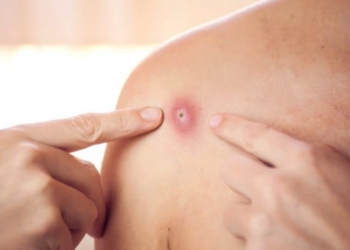 ​Rasti i parë i lisë së majmunëve është regjistruar në Serbi