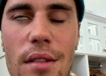 Justin Bieber vuan nga paraliza e fytyrës, anulon disa koncerte