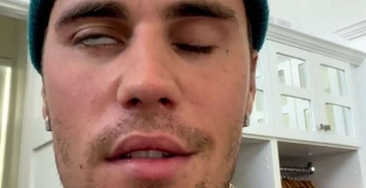 Justin Bieber vuan nga paraliza e fytyrës, anulon disa koncerte