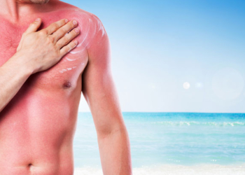 ​Ilaçet shtëpiake që lehtësojnë djegiet nga dielli