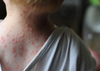 Simptoma e para të lisë së majmunit që mund të vërehen në fytyrë