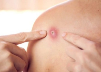 Nuk ka asnjë rast të konfirmuar me “linë e majmunëve” në Maqedoninë e Veriut