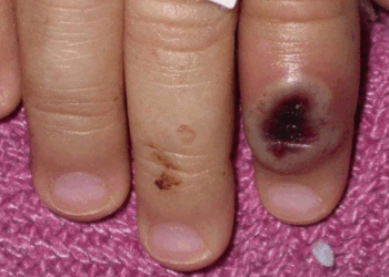 SHBA-ja shpall gjendjen e emergjencës shëndetësore për shkak të lisë së majmunëve