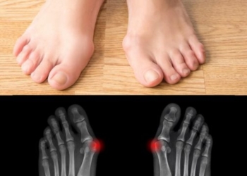 Bunion (gungat) në këmbë, A ka zgjidhje?