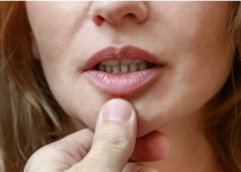 Nëse buzët tuaja kanë ndryshuar ngjyrën, kontaktoni menjëherë mjekun