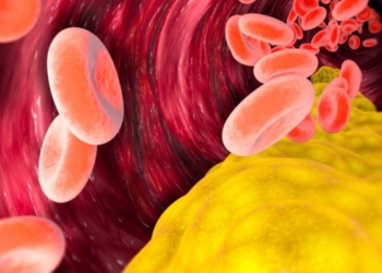 ​Kolesteroli i ngritur mund të tregohet edhe nga një ndjenjë e pazakontë në këmbë