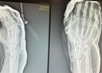 QKUK: Rast i rrallë, pacientit 27-vjeçar i shpëtohet parakrahu i prerë