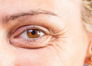 Rrudhat e syve – Si t’i largoni me metoda natyrale