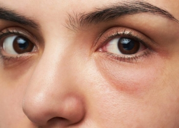 Metodat natyrale kundër rrathëve të zinj poshtë syve