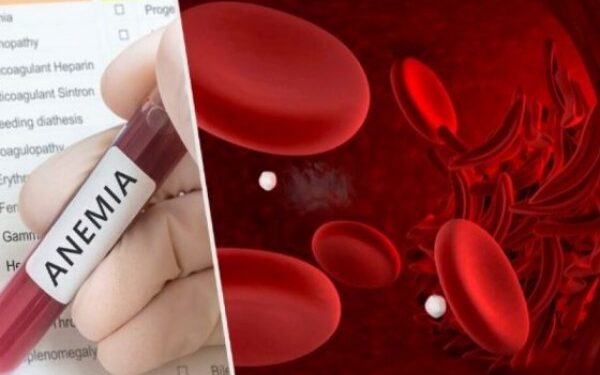Nëse vuani nga anemia, merrni këto ushqime
