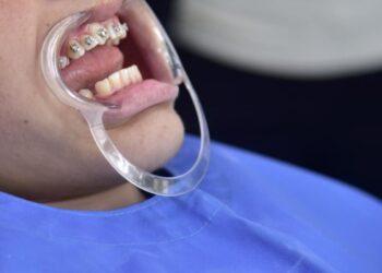 Klinika e Stomatologjisë nis ofrimin e shërbimit të protezave fikse