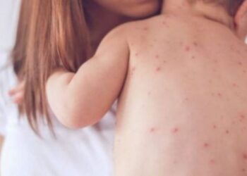 Në Kosovë nuk ka raste të konfirmuara me fruth