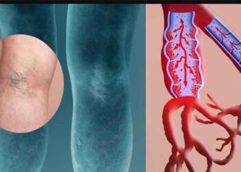 Rastet shëndetësore kur mund të rrezikoheni nga tromboza