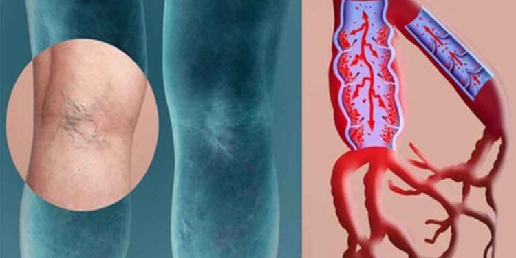 Rastet shëndetësore kur mund të rrezikoheni nga tromboza