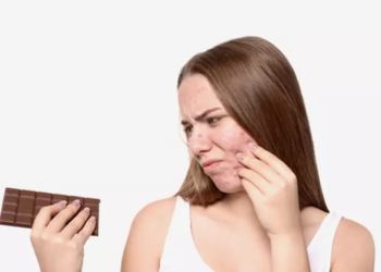 Ngrënia e çokollatës nuk shkakton akne