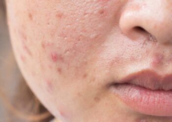 Shenjat e çrregullimeve hormonale që nuk duhen injoruar