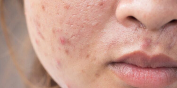 Shenjat e çrregullimeve hormonale që nuk duhen injoruar