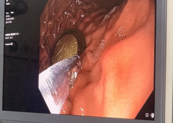 4-vjeçari nga Mitrovica gëlltit një monedhë metalike