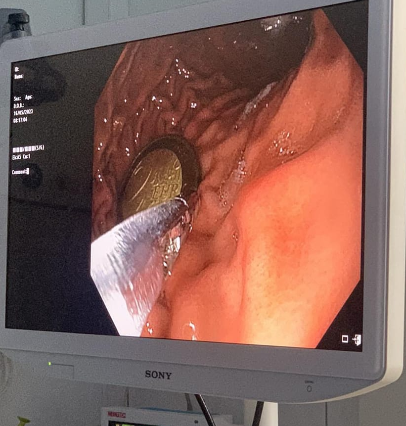 4-vjeçari nga Mitrovica gëlltit një monedhë metalike