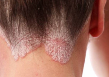 A është ngjitëse psoriaza? – Shkaqet dhe trajtimi i saj