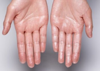 Hipohidroza ose mungesa e djersës – Cilat janë shkaqet dhe simptomat?