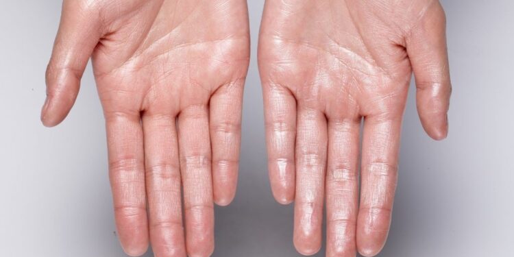 Hipohidroza ose mungesa e djersës – Cilat janë shkaqet dhe simptomat?