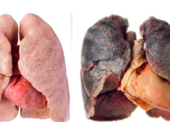 Këto janë shenjat e para të sëmundjeve të mushkërive të cilat duhet t’i dini