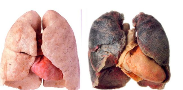 Këto janë shenjat e para të sëmundjeve të mushkërive të cilat duhet t’i dini