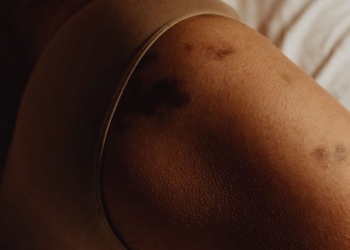 Keni shpesh mavijosje? Arsyet e mundshme pse ato shfaqen papritur