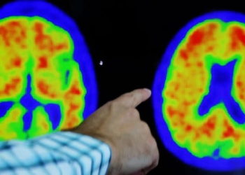 Donanemab, ilaç me rezultate premtuese kundër Alzheimerit