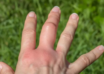 Keni ënjtje në pjesë të ndryshme të trupit? Atëherë mund të vuani nga kjo sëmundje