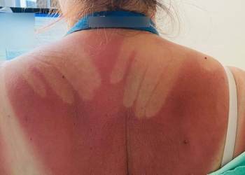 Djegiet nga dielli – 7 mënyrat si ti trajtojmë