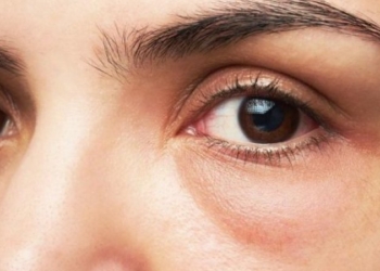 Sytë janë tregues të këtyre sëmundjeve