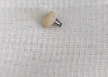 Gëlltiti një kurorë dhëmbësh, shpëtohet qytetarja pas intervenimit urgjentë nga mjekët