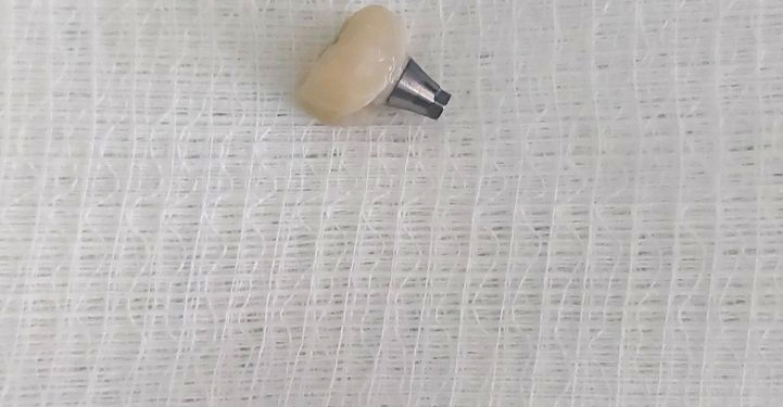 Gëlltiti një kurorë dhëmbësh, shpëtohet qytetarja pas intervenimit urgjentë nga mjekët