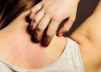 Këto probleme të lëkurës tregojnë mungesë të vitaminës D