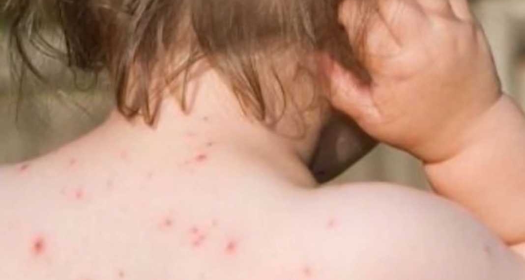 Shqipëri: Alarmi nga fruthi, cilat janë qarqet ku mund të ketë shpërthime epidemike