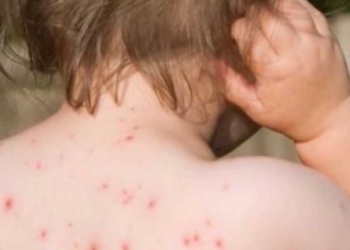 Shqipëri: Alarmi nga fruthi, cilat janë qarqet ku mund të ketë shpërthime epidemike