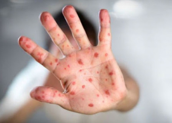 Shqipëri: Alarmi nga fruthi, cilat janë qarqet ku mund të ketë shpërthime epidemike