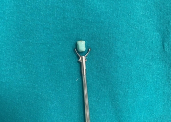 1-vjeçarit i largohet një pjesë e lodrës nga trupi përmes operacionit