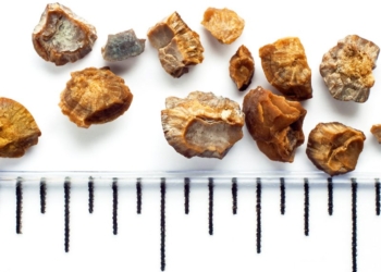 Si të kuptoni nëse keni gurë në veshka – Çfarë duhet të bëni