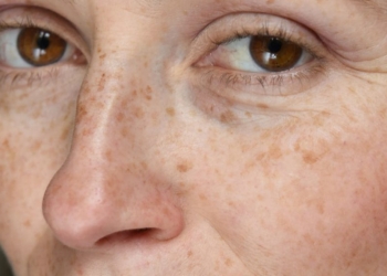 Njollat kafe në lëkurë – çfarë i shkakton dhe si t’i trajtoni në kushte shtëpie